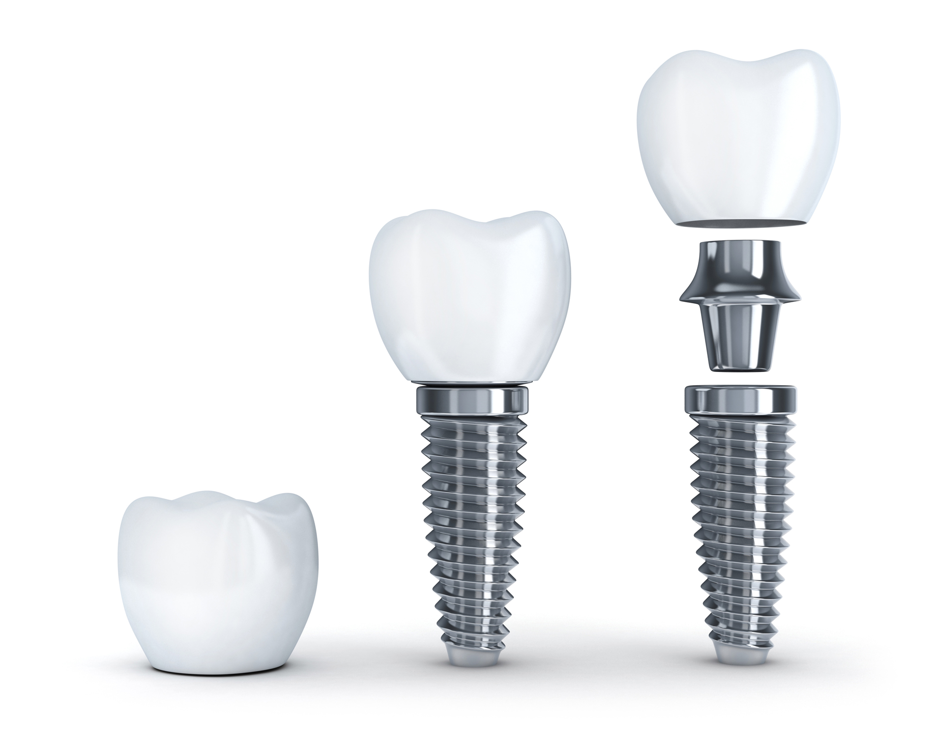 Implant dentar - tipuri, avantaje si pret