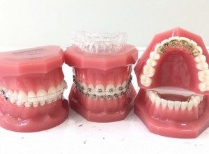 cum alegi aparatul dentar